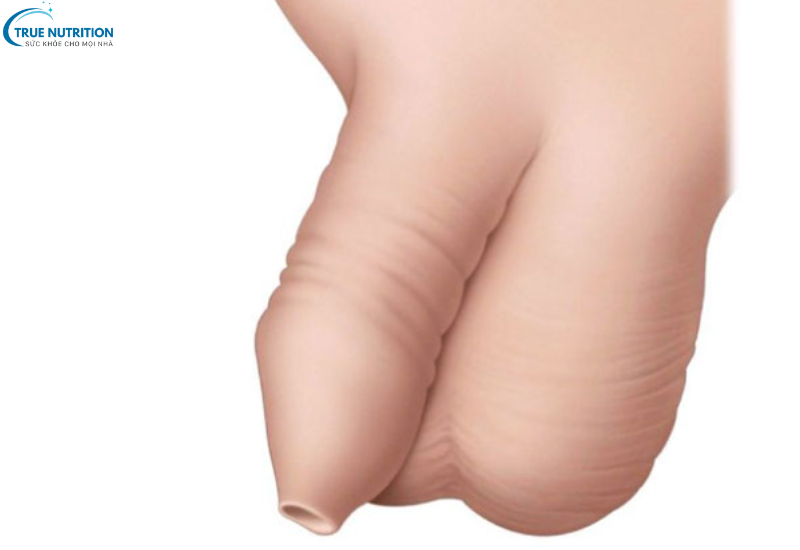 Cách Điều Trị Bệnh Hẹp Bao Quy Đầu: Lựa Chọn Phương Pháp Phù Hợp