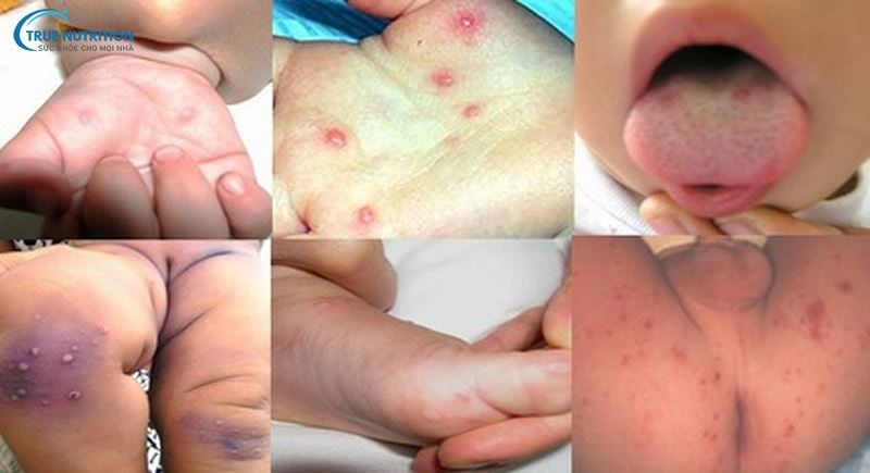 Cách Nhận Diện Hình Ảnh Trẻ Bị Chân Tay Miệng: Dấu Hiệu và Điều Trị