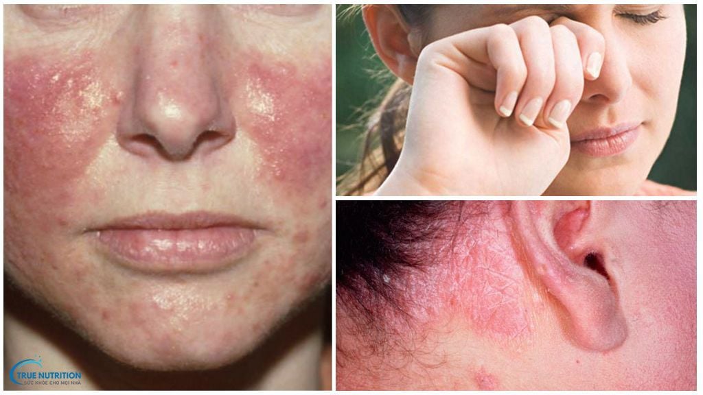 Cách Trị Demodex Tại Nhà: An Toàn Và Hiệu Quả