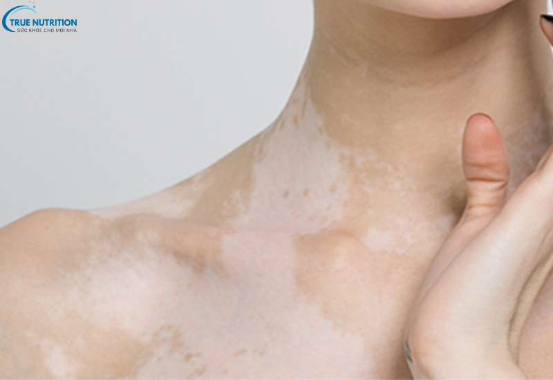 Cách Chữa Bệnh Bạch Biến: Những Phương Pháp Điều Trị Không Thể Bỏ Qua!