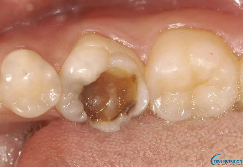 Dấu Hiệu Bệnh Viêm Tủy Răng: Phát Hiện Để Tránh Biến Chứng Nguy Hiểm