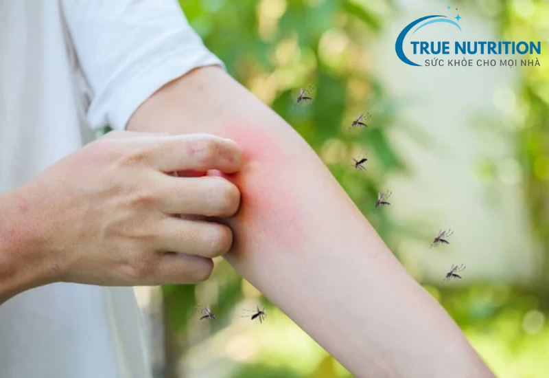 Dị Ứng Côn Trùng: Triệu Chứng, Cách Chữa Và Phòng Ngừa Hiệu Quả