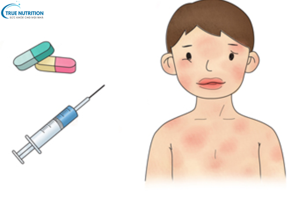 Cách Điều Trị Dị Ứng Thuốc, Phương Pháp và Lời Khuyên Cần Biết