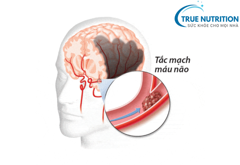 Đột quỵ ở não và đột quỵ ở tim mạch - những yếu tố nguy cơ quan trọng