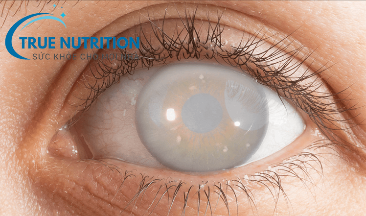 Đục Thủy Tinh Thể Do Tiểu Đường: Biến Chứng Cần Phòng Ngừa Để Tránh Mù Lòa