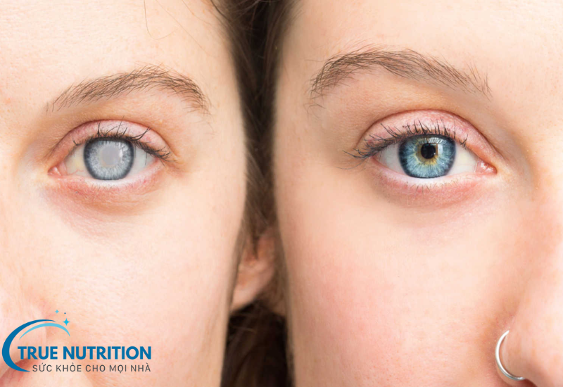 Đục thủy tinh thể: Nhận diện sớm và điều trị hiệu quả