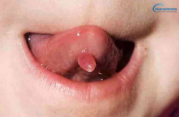Dưới Lưỡi Nổi Cục Thịt: Nguyên Nhân, Điều Trị, Bệnh Lý