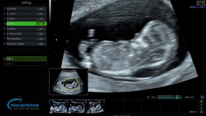 Xét Nghiệm Độ Mờ Da Gáy Giá Bao Nhiêu Tiền, Siêu Âm Tuần Bao Nhiêu?