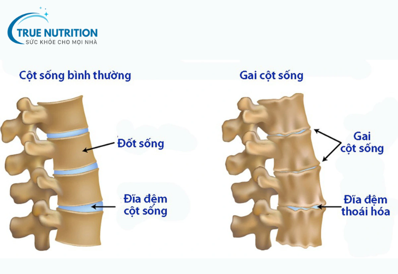Bệnh gai cột sống - hiểu đúng và phòng ngừa hiệu quả