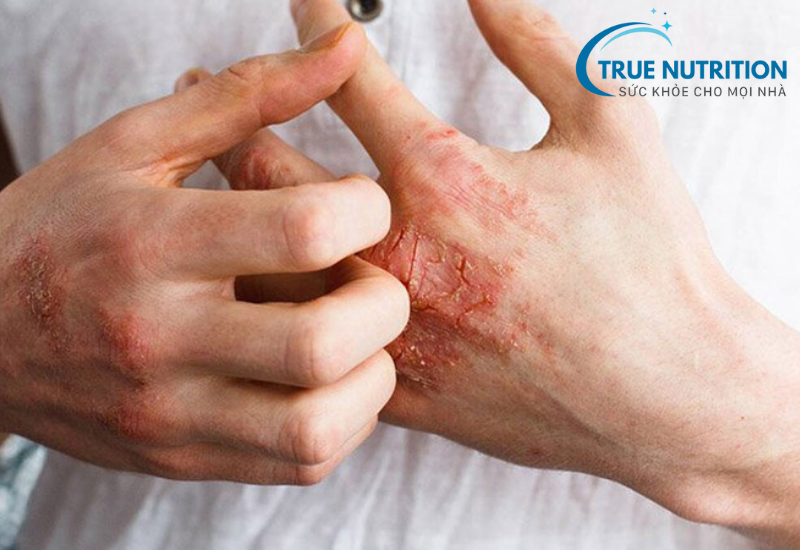 Giang Mai: Bệnh Lây Truyền Qua Đường Tình Dục Cần Cảnh Giác