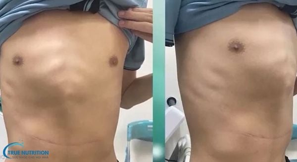 Hình Ảnh Trẻ Bị Nhô Xương Ức Gà: Nguyên Nhân & Phương Pháp Điều Trị