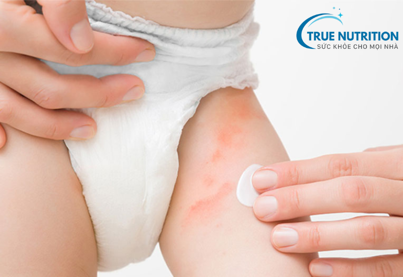 Chữa hăm tã cho trẻ sơ sinh - Bí quyết hay chia sẻ cùng mẹ