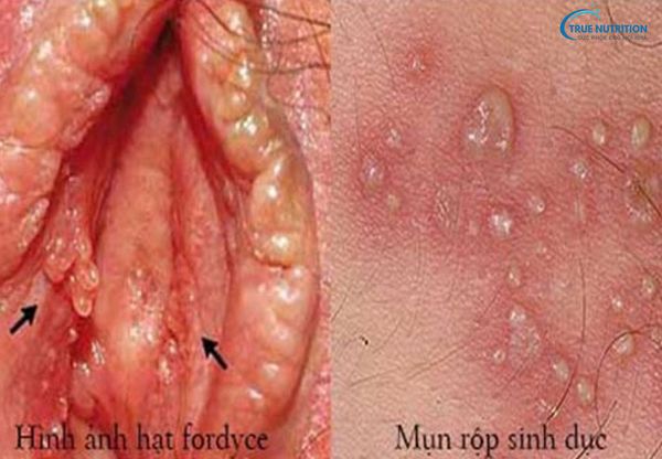 Hạt Fordyce ở vùng kín nữ: Nguyên nhân, dấu hiệu và cách điều trị