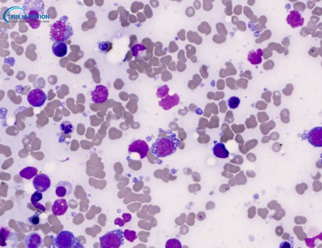 U Lympho Không Hodgkin Tế Bào B Lớn Tỏa Rộng Tìm Hiểu Về Căn Bệnh, Nguyên Nhân, Triệu Chứng Và Phương Pháp Điều Trị