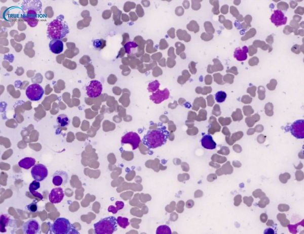 U Lympho Không Hodgkin Tế Bào B Lớn Tỏa Rộng Tìm Hiểu Về Căn Bệnh, Nguyên Nhân, Triệu Chứng Và Phương Pháp Điều Trị