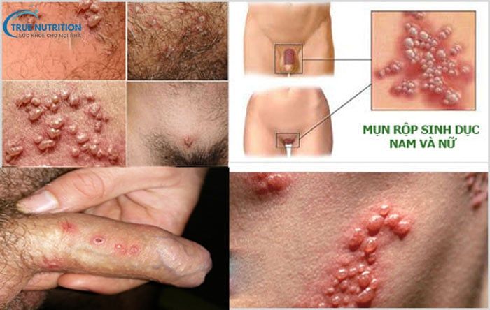 Hình Ảnh Mụn Rộp Sinh Dục Nhận Biết Sớm và Phòng Ngừa Hiệu Quả