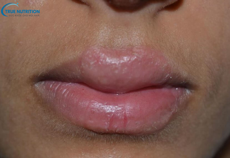 Bệnh Hội Chứng Jacobsen Là Gì? Điều Cần Biết Về Rối Loạn Nhiễm Sắc Thể