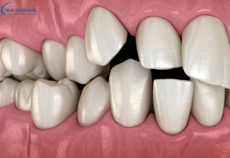 Khớp Cắn Lệch: Dấu Hiệu Nhận Biết và Giải Pháp Cho Nụ Cười Hoàn Hảo