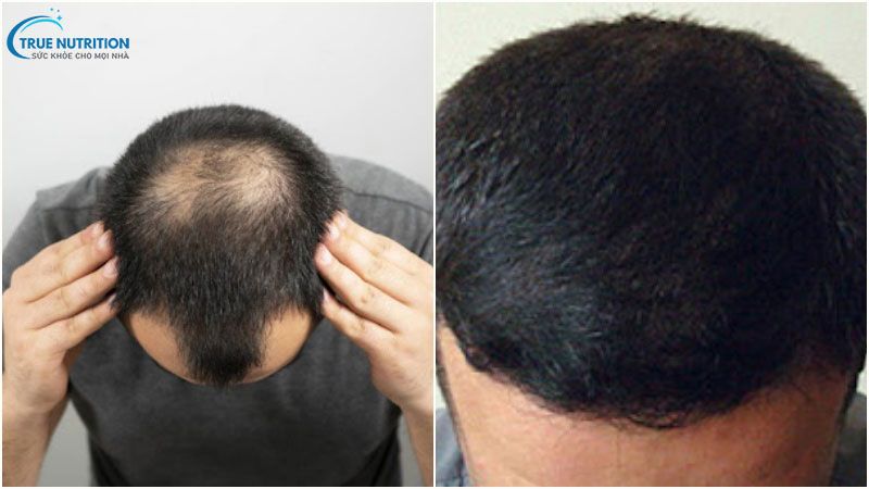 Lăn Kim Mọc Tóc Là Gì? Có Đau Không? Bao Lâu Thì Có Hiệu Quả?