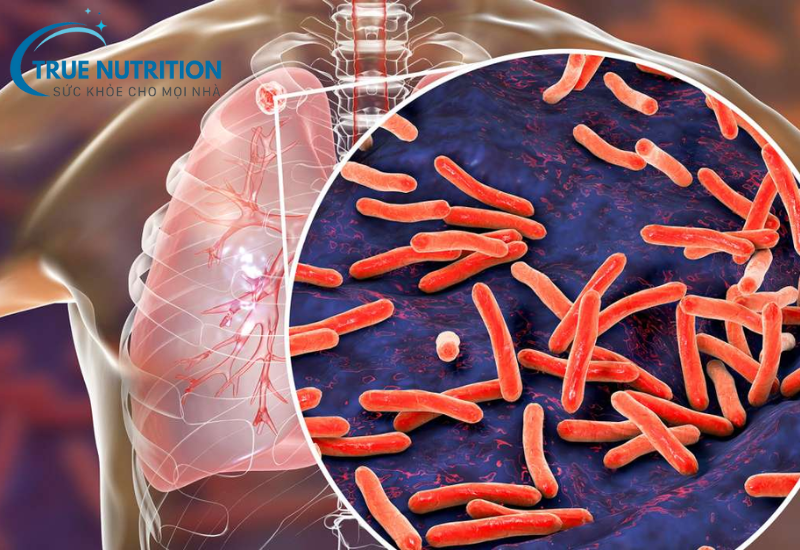 Lao: Thông Tin Toàn Diện, Nguyên Nhân, Triệu Chứng và Cách Điều Trị