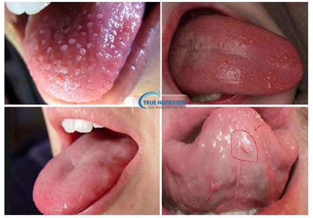 Lưỡi Nổi Hạt: Nguyên Nhân, Có Tự Khỏi Không, Có Nguy Hiểm Không?