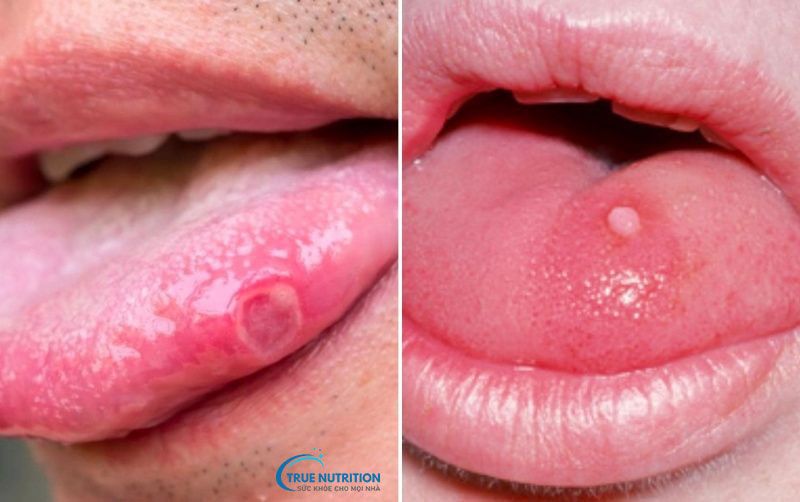 Lưỡi Nổi Mụn Thịt Nguy Hiểm Không? Nguyên Nhân, Bệnh Lý?