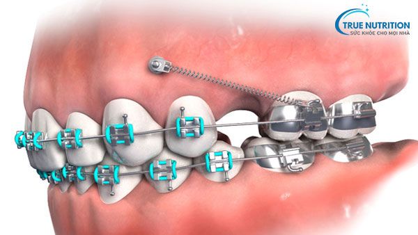 Minivis Chỉnh Nha, Giá, Tác Dụng, Lưu Ý, Thời Gian