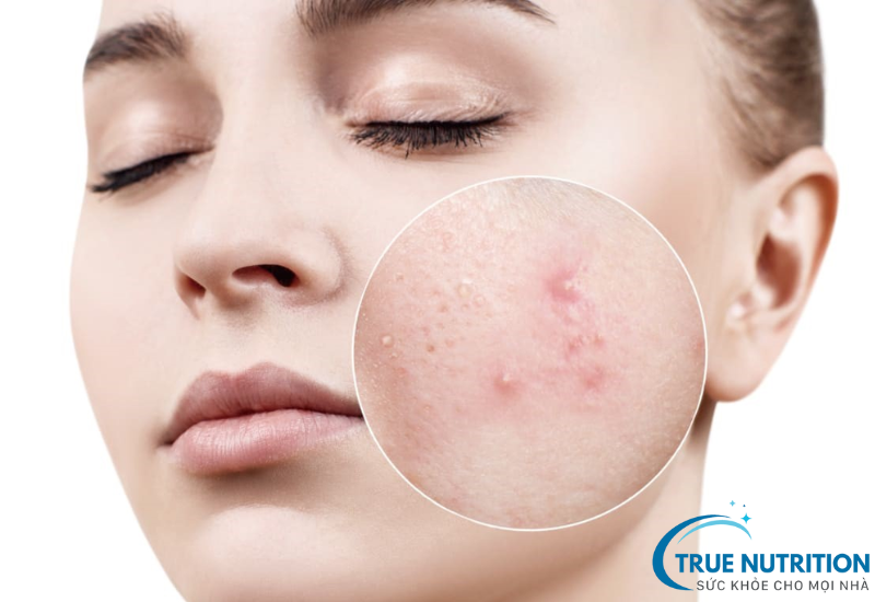 Mụn Trứng Cá Là Gì? Phân Tích Nguyên Nhân Gây Mụn Và Giải Pháp