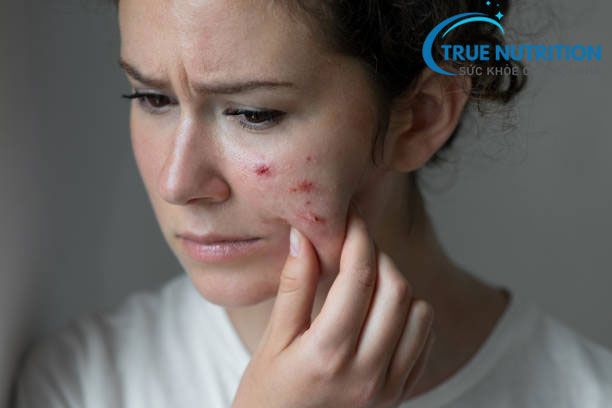 Nguy Cơ Viêm Nhiễm Do Tự Nặn Mụn Tại Nhà?