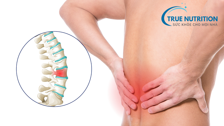 Nguyên nhân thoái hóa đốt sống thắt lưng: Tìm hiểu Chi Tiết Đầy Đủ Các Nguyên nhân