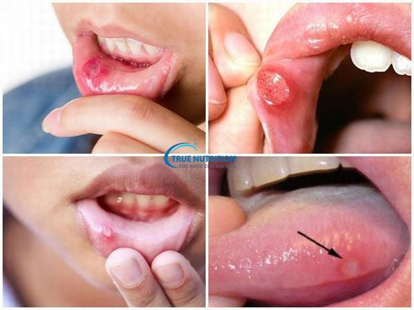 Nhận Định Hình Ảnh Bị Lở Miệng: Phân Biệt, Cách Điều Trị