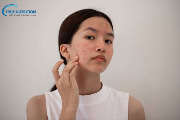 Nổi mụn nhiều có phải bệnh gan không? Đừng Chủ Quan!