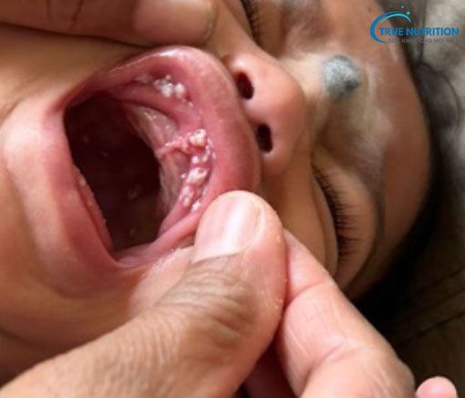 Nổi Mụn Trắng Trong Miệng Không: Đau Nguyên Nhân & Cách Xử Lý