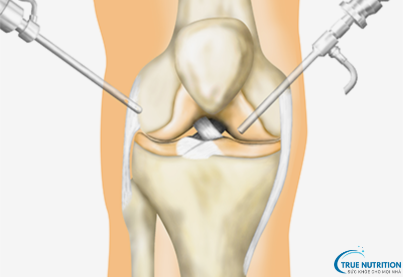 Nội Soi Khớp Gối: Phương Pháp Chẩn Đoán Và Điều Trị Các Bệnh Lý Khớp