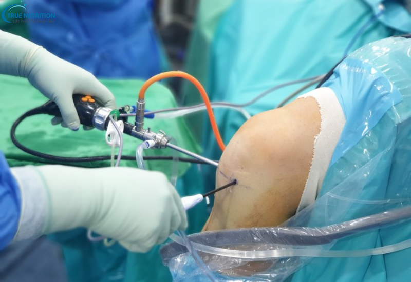 Phẫu Thuật Nội Soi Khớp: Giải Pháp Điều Trị Cho Các Vấn Đề Xương Khớp