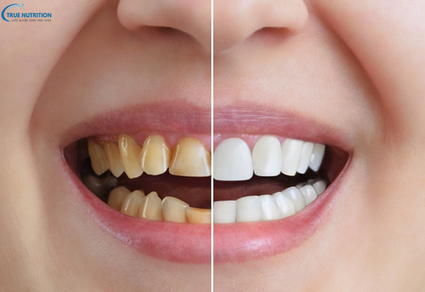 Cách Trị Răng Xỉn Màu: Bí Quyết Cho Nụ Cười Trắng Sáng Suốt Cả Ngày