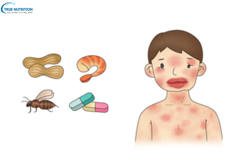 Triệu Chứng Sốc Phản Vệ: Dấu Hiệu Nguy Hiểm Và Cách Xử Trí Kịp Thời