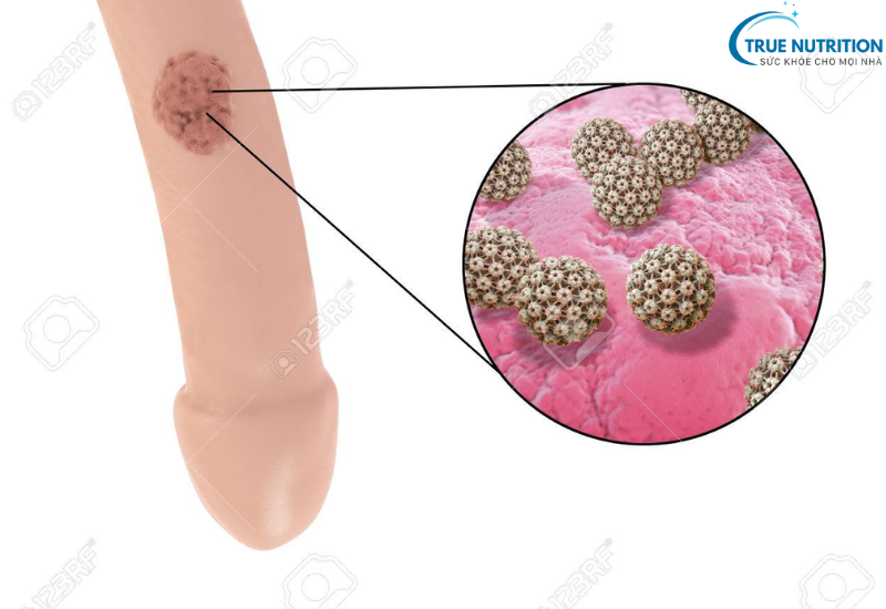 Sùi Mào Gà: Triệu Chứng Bạn Cần Biết Để Phát Hiện Và Can Thiệp Sớm