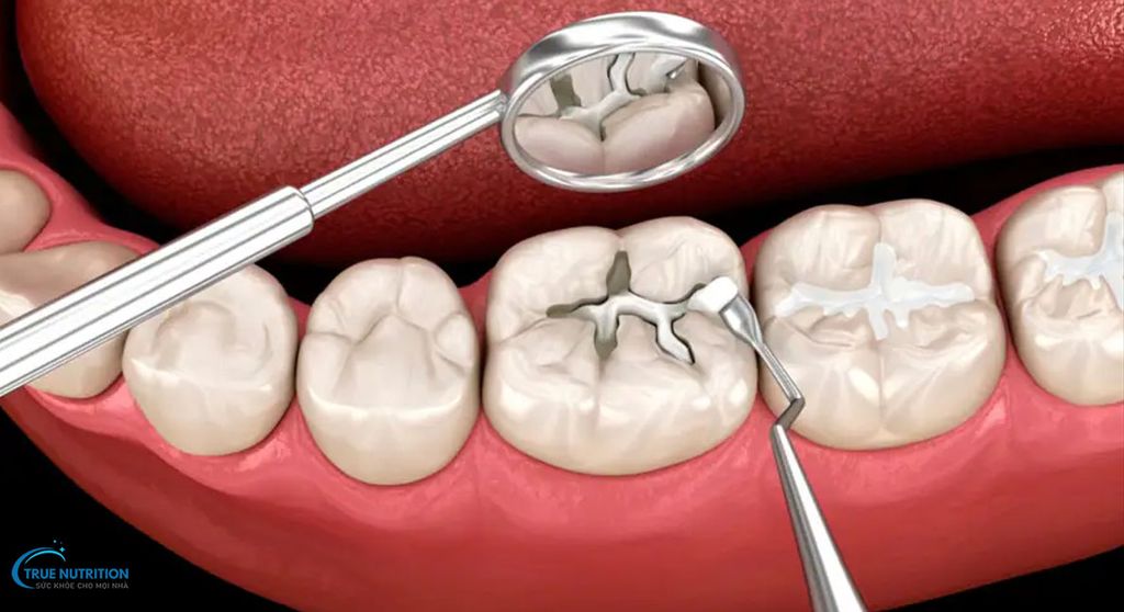 Tác Hại Của Việc Trám Răng, Chi Phí, Tuổi Thọ, Chăm Sóc Đúng Cách