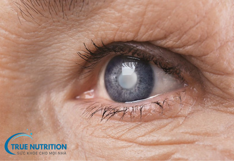 Tăng Nhãn Áp: Bệnh Lý Nguy Hiểm Cần Cảnh Giác