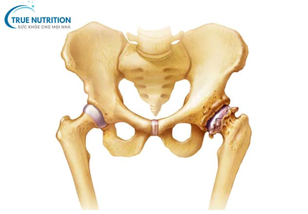 Thoái hóa khớp háng vì sao dễ mắc?