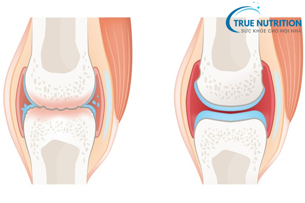 Độ tuổi nào dễ mắc thoái hóa khớp gối? Triệu chứng và cách phòng ngừa