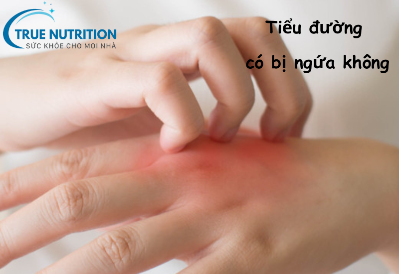 Tiểu Đường Có Bị Ngứa Không? Nguyên Nhân Và Cách Xử Lý