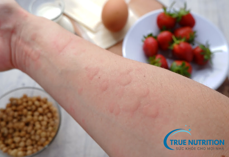 Top 3 nguyên nhân gây dị ứng thức ăn và cách phòng ngừa hiệu quả