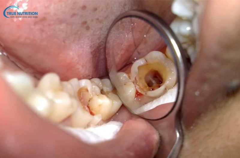 Triệu Chứng Sau Khi Lấy Tủy Răng: Phân Biệt Bình Thường Và Bất Thường