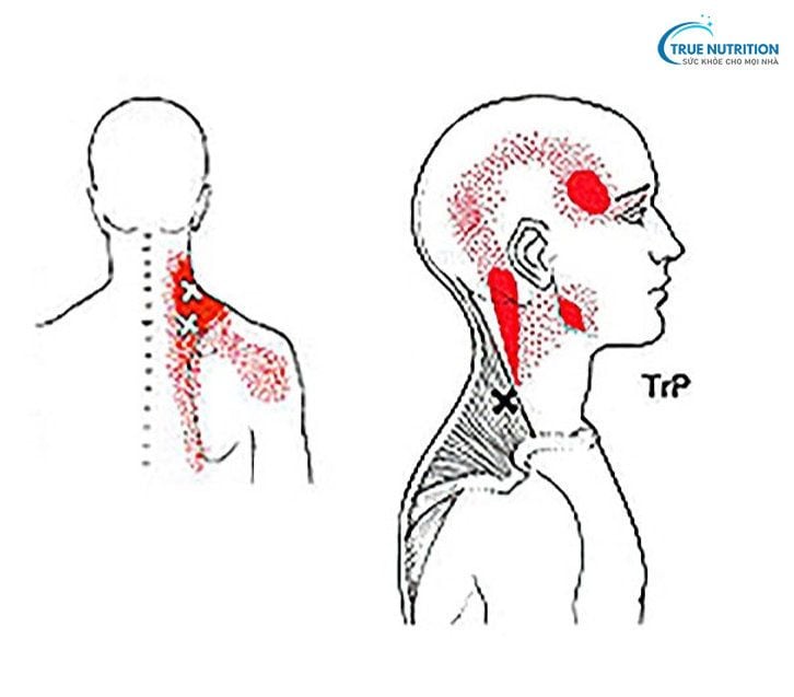 Trigger Point Là Gì? Nguyên Nhân & Liệu Pháp Điều Trị