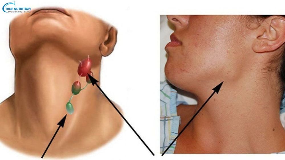 U Lympho Không Hodgkin có thể sống được bao lâu?  Yếu Tố Quyết Định Tuổi Thọ