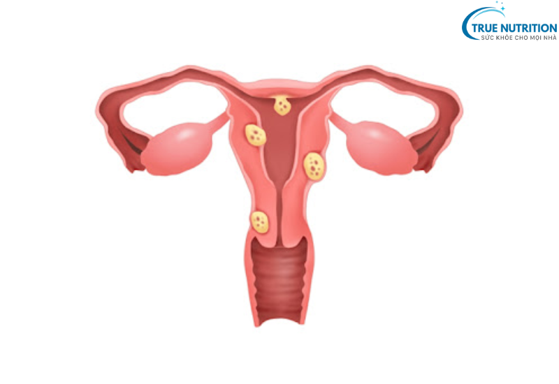 Bệnh U Xơ Tử Cung: Cách Nhận Biết, Phòng Ngừa Và Điều Trị Kịp Thời