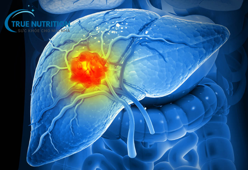 Ung Thư Gan: Các thông tin cần biết và phương pháp điều trị