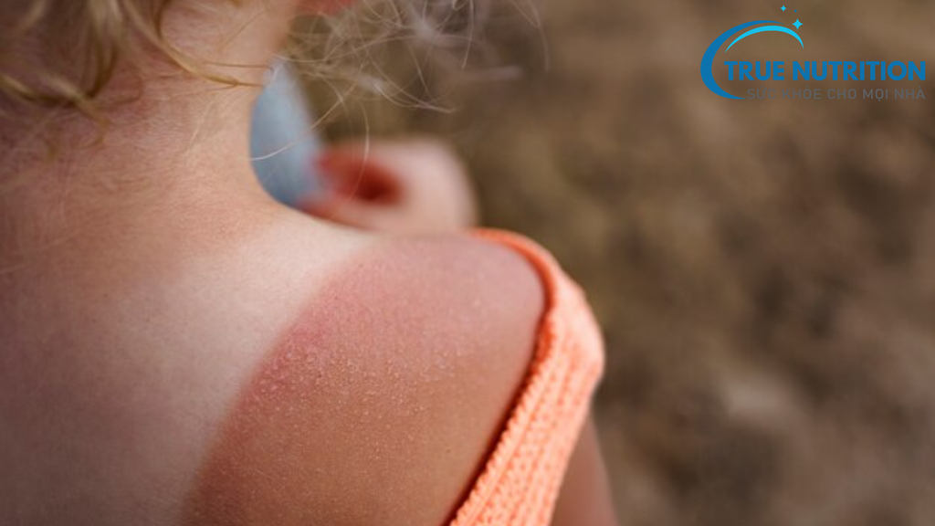 Giải Pháp Nhanh Chóng Để Phục Hồi Da Bỏng Nắng: Những Mẹo Cứu Cánh Tức Thì!